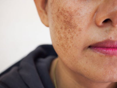 Hyperpigmentation