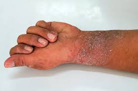 Dry - itchy & sensitive skin