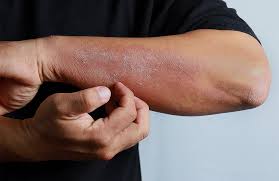 Eczema